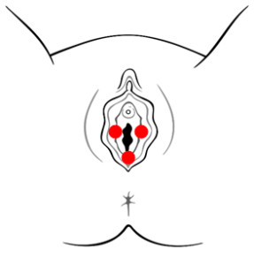 understanding_vulvodynia_1